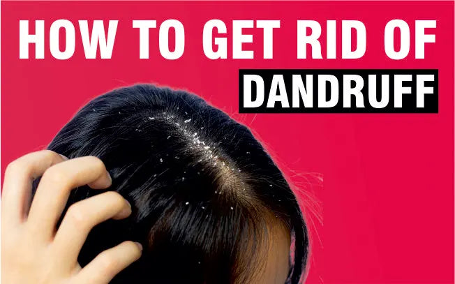 Tips To Get Rid Of Dandruff