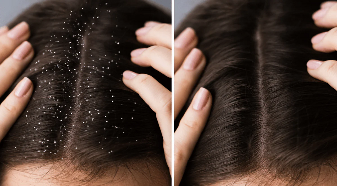 Dryness vs. Dandruff – No, They’re Not the Same!